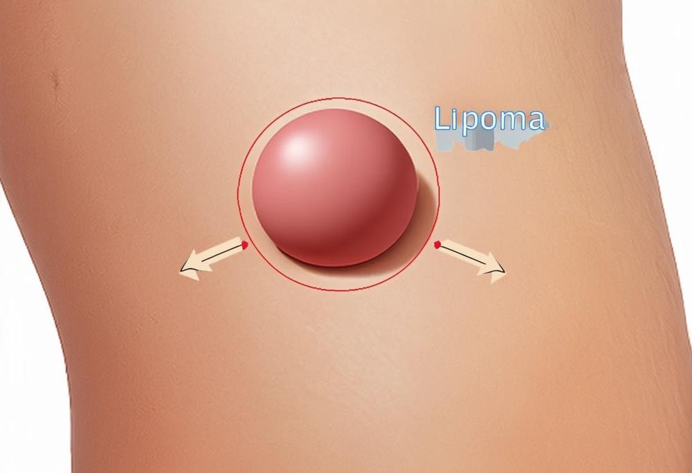 lipoma illustration